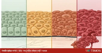 Loạn sản độ cao: Phát hiện sớm để ngăn ngừa ung thư