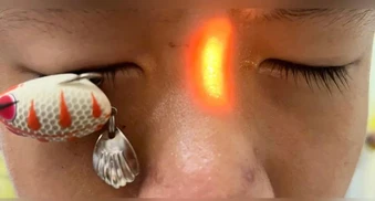 Lưỡi câu ghim thẳng vào mắt bé trai 13 tuổi gây mù