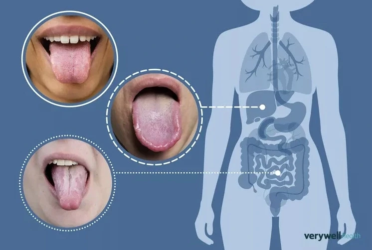 Lưỡi tiết lộ gì về sức khỏe? Lưỡi tiết lộ gì về sức khỏe?