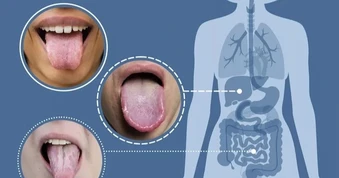 Lưỡi tiết lộ gì về sức khỏe?