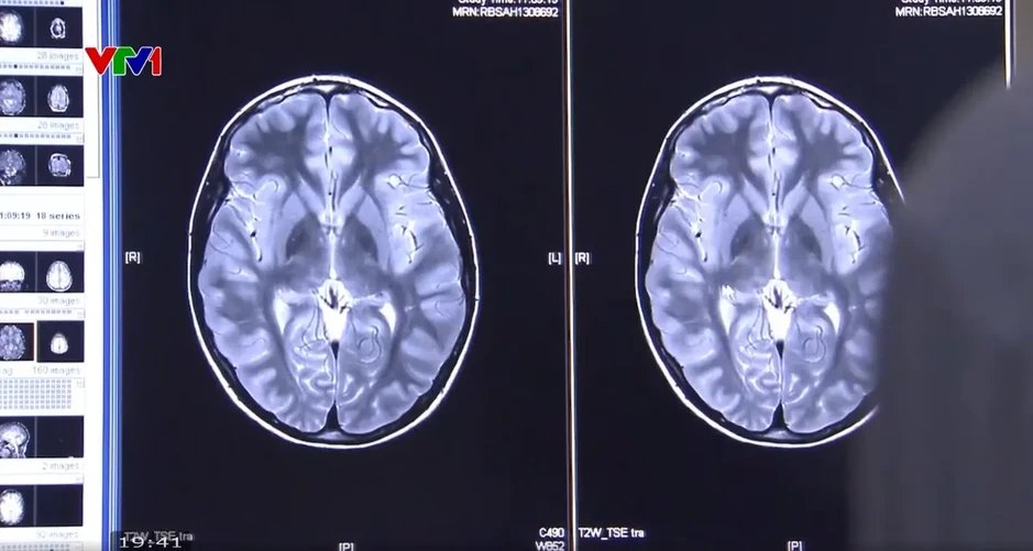 Mỹ phát triển phương pháp xét nghiệm máu giúp phát hiện sớm bệnh Alzheimer Mỹ phát triển phương pháp xét nghiệm máu giúp phát hiện sớm bệnh Alzheimer