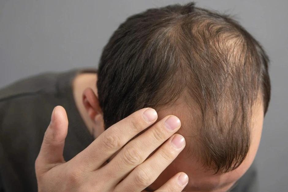 Mỹ thu hồi hàng nghìn chai thuốc chứa hoạt chất quen thuộc trị hói đầu Mỹ thu hồi hàng nghìn chai thuốc chứa hoạt chất quen thuộc trị hói đầu