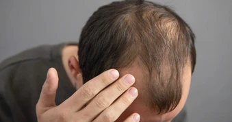 Mỹ thu hồi hàng nghìn chai thuốc chứa hoạt chất quen thuộc trị hói đầu