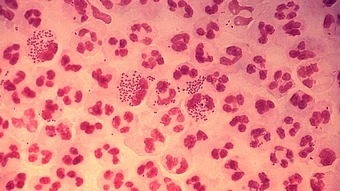 Mắc bệnh lậu sau quan hệ với bạn gái quen một năm