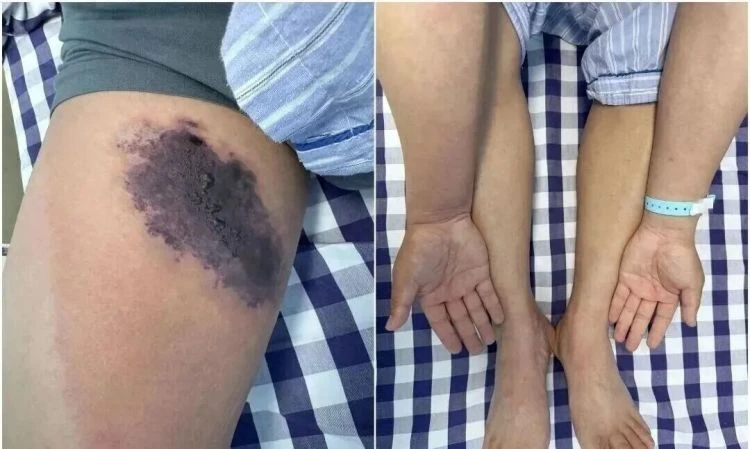 Mặc chiếc quần cũ, người đàn ông suýt "nhiễm độc toàn thân" Mặc chiếc quần cũ, người đàn ông suýt "nhiễm độc toàn thân"