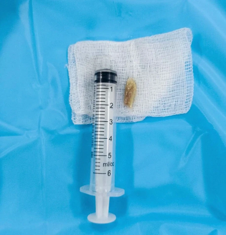 Mắc xương vịt 2cm ở thực quản và thanh quản, người phụ nữ không ăn không nói được Mắc xương vịt 2cm ở thực quản và thanh quản, người phụ nữ không ăn không nói được
