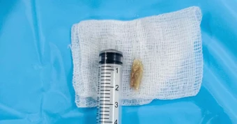 Mắc xương vịt 2cm ở thực quản và thanh quản, người phụ nữ không ăn không nói được