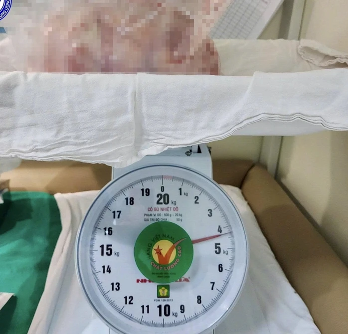 Mang khối u buồng trứng 4 kg, thiếu nữ bị nhầm là tăng cân