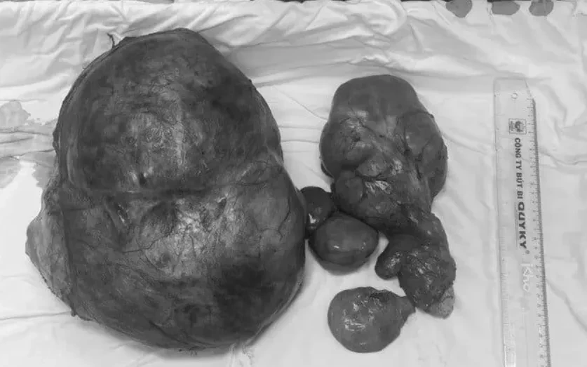Mang khối u gần 8kg vì tự uống thuốc nam Mang khối u gần 8kg vì tự uống thuốc nam
