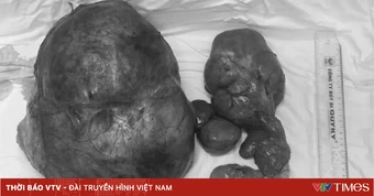 Mang khối u gần 8kg vì tự uống thuốc nam