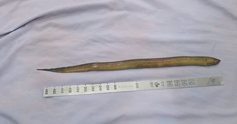 Mổ cấp cứu lấy con lươn dài 50 cm ra khỏi bụng bệnh nhân