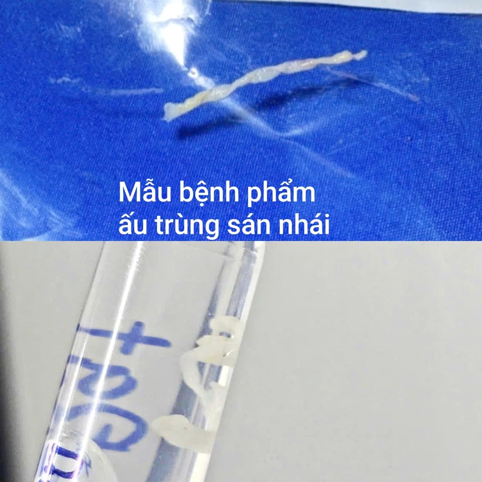 Mổ khối bất thường ở đùi bệnh nhân, bác sĩ phát hiện ấu trùng dài 7cm Mổ khối bất thường ở đùi bệnh nhân, bác sĩ phát hiện ấu trùng dài 7cm