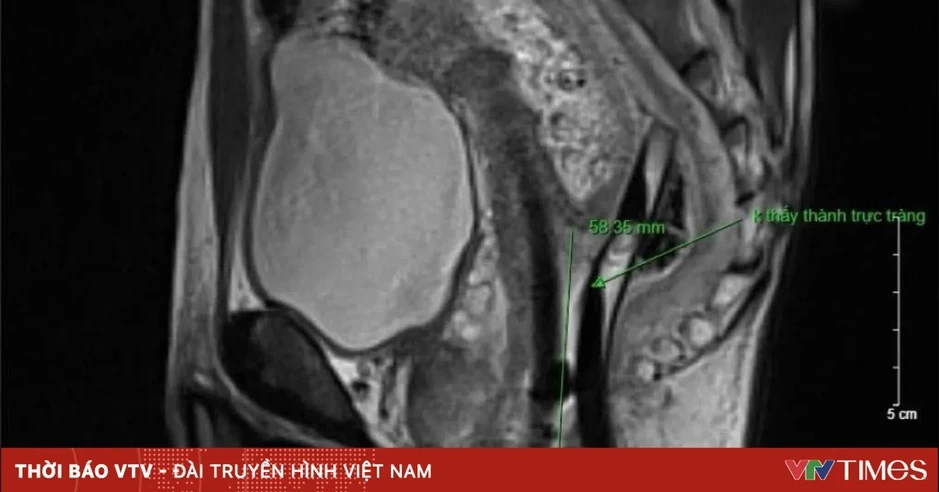 Một ca tổn thương đặc biệt hiếm gặp, chưa từng ghi nhận tại Việt Nam Một ca tổn thương đặc biệt hiếm gặp, chưa từng ghi nhận tại Việt Nam