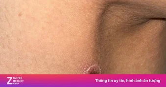 Một vết đốt khô, không đau khiến người phụ nữ lâm bạo bệnh