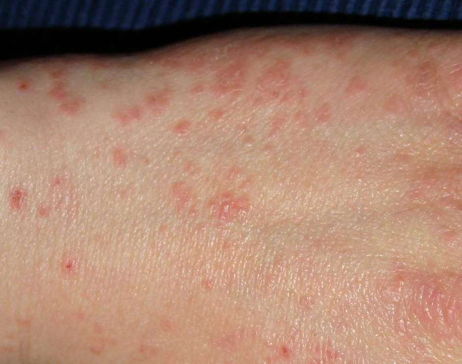 Nam HLV thể hình 29 tuổi phát hiện nhiễm HIV khi khám da liễu, cách anh ta bị lây nhiễm khiến người trẻ giật mình Nam HLV thể hình 29 tuổi phát hiện nhiễm HIV khi khám da liễu, cách anh ta bị lây nhiễm khiến người trẻ giật mình