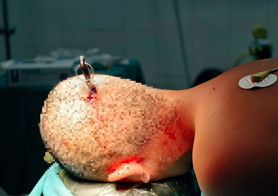 Nam sinh 12 tuổi cấp cứu vì trò đùa dại của bạn, để bút bi dưới ghế ngồi Nam sinh 12 tuổi cấp cứu vì trò đùa dại của bạn, để bút bi dưới ghế ngồi