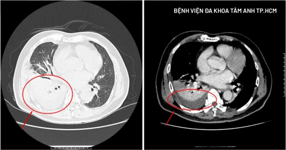 Nấm tấn công phổi gây tràn dịch - Báo TinVina