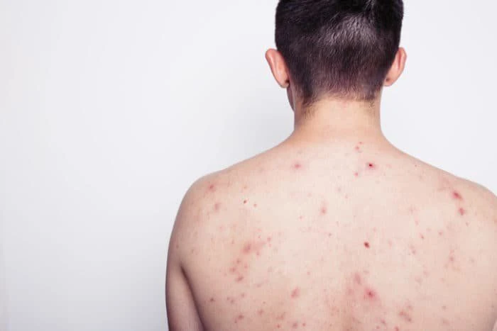 Nam thanh niên 23 tuổi nhiễm HIV sau khi tham gia lễ hội té nước tại Thái Lan Nam thanh niên 23 tuổi nhiễm HIV sau khi tham gia lễ hội té nước tại Thái Lan