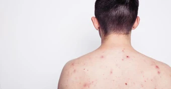 Nam thanh niên 23 tuổi nhiễm HIV sau khi tham gia lễ hội té nước tại Thái Lan