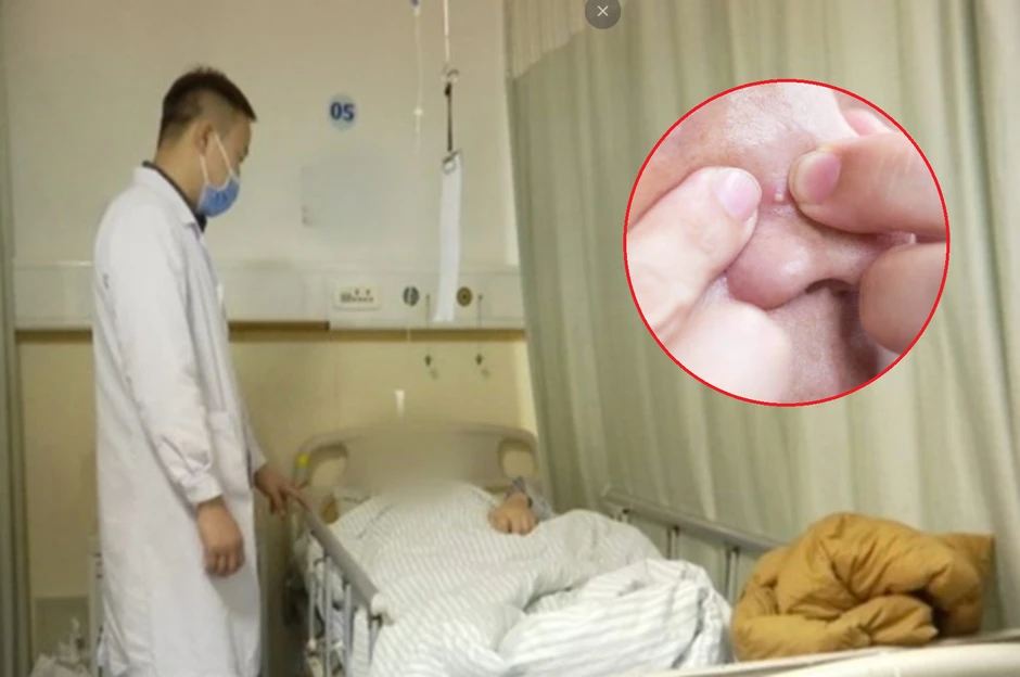 Nặn mụn trên mặt, người đàn ông 51 tuổi phát triển khối u ác tính Nặn mụn trên mặt, người đàn ông 51 tuổi phát triển khối u ác tính
