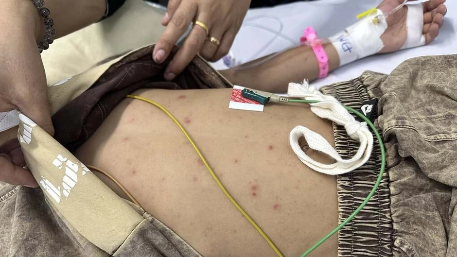 Não mô cầu có thể trở nặng sau vài giờ đau đầu - Báo TinVina Não mô cầu có thể trở nặng sau vài giờ đau đầu - Báo TinVina