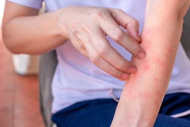 Nếu bạn có hai vùng da bị ngứa dai dẳng trên cơ thể, hãy cảnh giác vì đó có thể là dấu hiệu của ung thư gan Nếu bạn có hai vùng da bị ngứa dai dẳng trên cơ thể, hãy cảnh giác vì đó có thể là dấu hiệu của ung thư gan