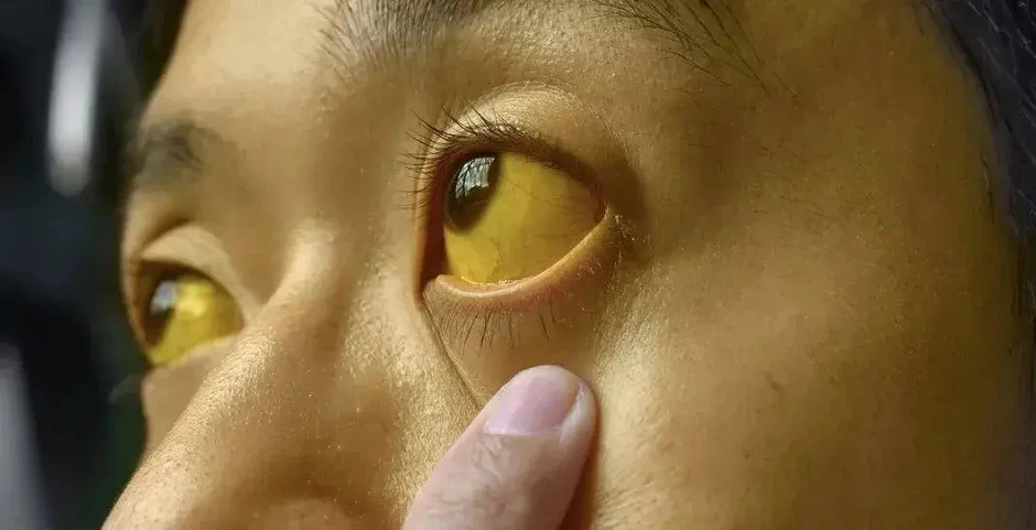 Nếu mắt có 6 thứ, đi khám ung thư ngay còn kịp! Nếu mắt có 6 thứ, đi khám ung thư ngay còn kịp!