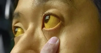 Nếu mắt có 6 thứ, đi khám ung thư ngay còn kịp!