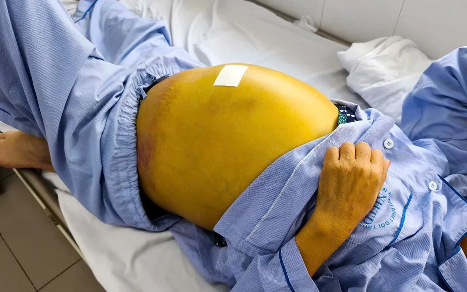 Ngày 28/7: Chung tay loại trừ viêm gan virus Ngày 28/7: Chung tay loại trừ viêm gan virus