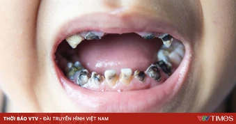 Ngày Sức khỏe Răng miệng thế giới (20/3): "Nụ cười đẹp, cuộc sống vui"
