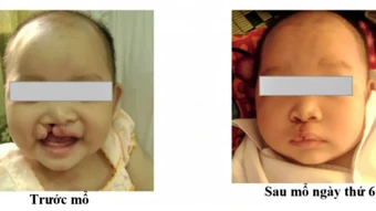 Nghệ An tiếp nhận viện trợ chăm sóc trẻ em bị dị tật khe hở môi, vòm miệng