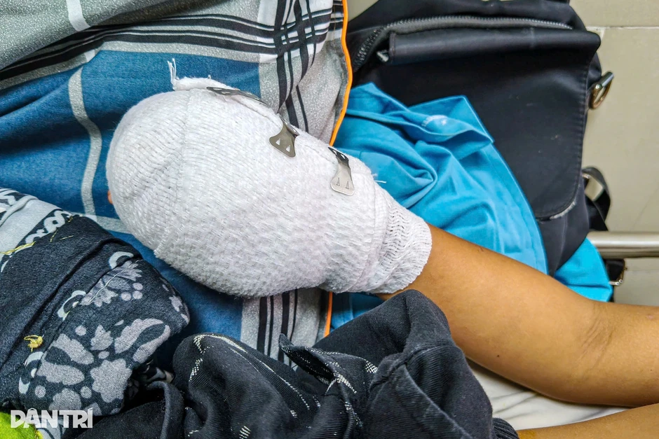 Nghi điện thoại phát nổ, bé trai 9 tuổi nhập viện với bàn tay dập nát Nghi điện thoại phát nổ, bé trai 9 tuổi nhập viện với bàn tay dập nát