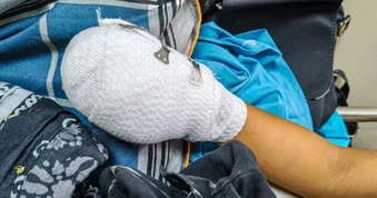 Nghi điện thoại phát nổ, bé trai 9 tuổi nhập viện với bàn tay dập nát
