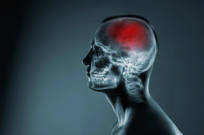 Nghiên cứu mới về đột quỵ lật đổ quan niệm y học hàng thập kỷ Nghiên cứu mới về đột quỵ lật đổ quan niệm y học hàng thập kỷ