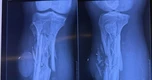 Ngư dân bị cáp tời cuốn nát chân được phẫu thuật cứu chi sau 3 ngày lênh đênh trên biển