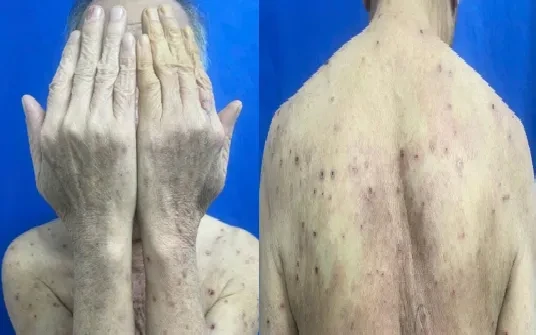 Ngứa kéo dài ở người cao tuổi có thể là bệnh da tự miễn nguy hiểm Ngứa kéo dài ở người cao tuổi có thể là bệnh da tự miễn nguy hiểm