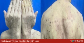 Ngứa kéo dài ở người cao tuổi có thể là bệnh da tự miễn nguy hiểm