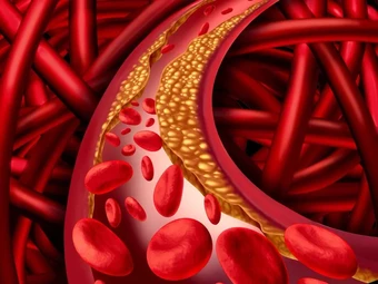 Người có thể trạng gầy vẫn bị rối loạn mỡ máu