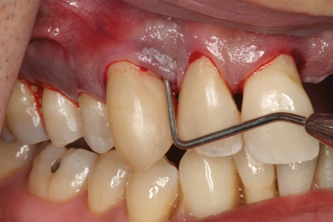 Người đàn ông 51 tuổi khổ sở vì "khối u" tim lỗ chỗ như tổ ong bắp cày, bác sĩ tức giận: Bệnh từ miệng mà ra! Người đàn ông 51 tuổi khổ sở vì "khối u" tim lỗ chỗ như tổ ong bắp cày, bác sĩ tức giận: Bệnh từ miệng mà ra!