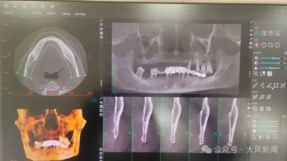Người đàn ông đi khám chiếc răng đau nhưng bị nhổ cả hàm