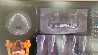 Người đàn ông đi khám chiếc răng đau nhưng bị nhổ cả hàm