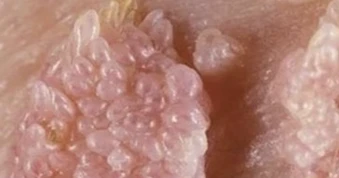 Người đàn ông gần 70 tuổi mắc sùi mào gà sau quan hệ không an toàn