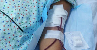 Người đàn ông mất hoàn toàn chức năng thận sau một đợt sốt siêu vi