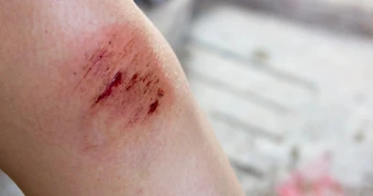 Người đàn ông nhiễm khuẩn huyết nguy kịch sau khi chế biến thịt lợn sống