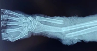 Người đàn ông ở Lâm Đồng bị máy nghiền đá cuốn đứt cẳng tay