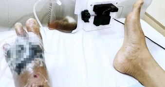 Người đàn ông phải cắt 3 ngón chân sau khi ngâm "nước lá thuốc" chữa bỏng