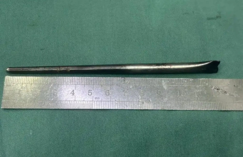 Người đàn ông sống 8 năm với chiếc đũa dài 12cm trong cổ họng Người đàn ông sống 8 năm với chiếc đũa dài 12cm trong cổ họng