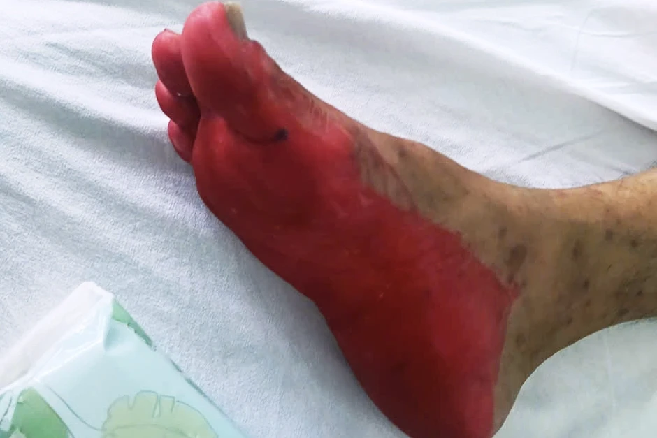 Người đàn ông tím tái, rộp loét khắp người sau 3 lần dùng thuốc nhỏ mắt Người đàn ông tím tái, rộp loét khắp người sau 3 lần dùng thuốc nhỏ mắt
