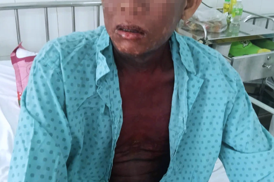 Người đàn ông tím tái, rộp loét khắp người sau 3 lần dùng thuốc nhỏ mắt Người đàn ông tím tái, rộp loét khắp người sau 3 lần dùng thuốc nhỏ mắt