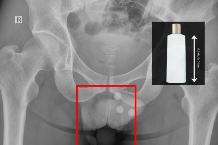 Người đàn ông vào viện cấp cứu với chai nhựa dài trong trực tràng Người đàn ông vào viện cấp cứu với chai nhựa dài trong trực tràng